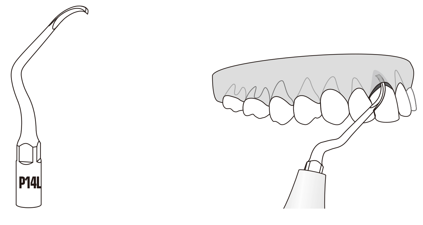 Сфера применения наконечника для скалера